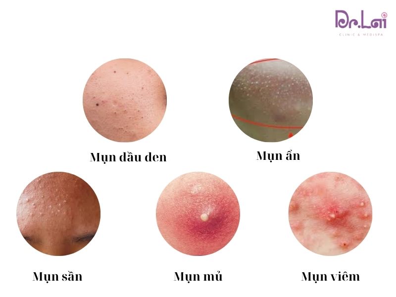 Tùy vào từng loại mụn có mức giá khác nhau