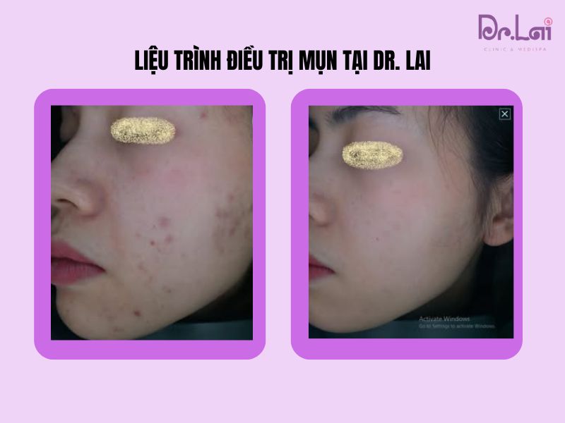 Điều trị mụn tại Dr. Lai