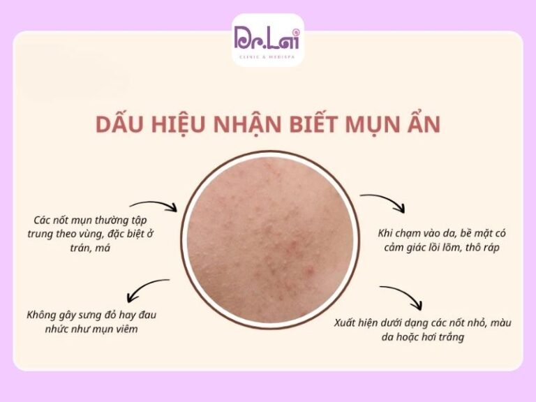 Mụn ẩn dưới da