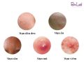 Các loại mụn phổ biến