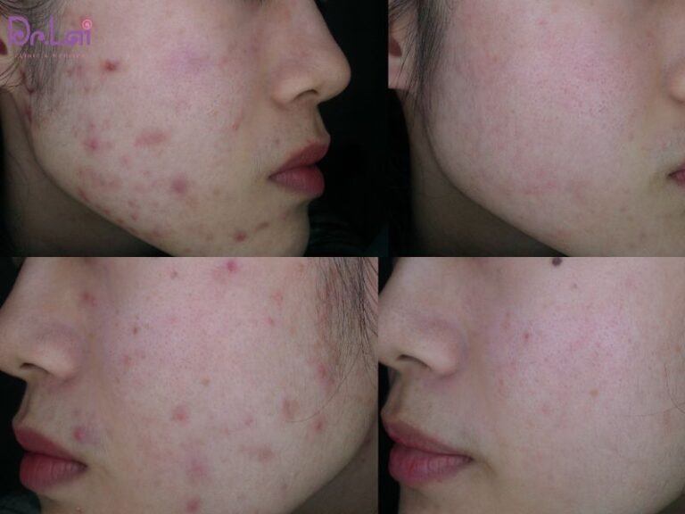 Điều trị thâm mụn bằng laser tại Dr.Lai