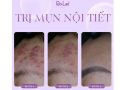 Giải pháp trị mụn an toàn, chuẩn y khoa