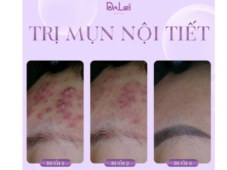 Giải pháp trị mụn an toàn, chuẩn y khoa